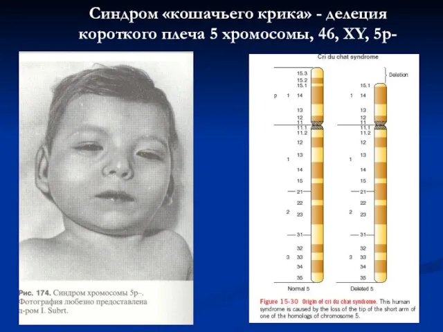 Синдром «кошачьего крика» - делеция короткого плеча 5 хромосомы, 46, ХY, 5р-