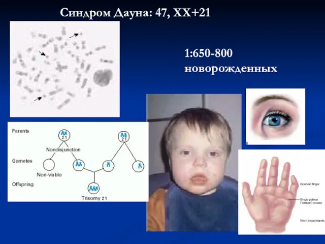 Синдром Дауна: 47, ХХ+21 1:650-800 новорожденных