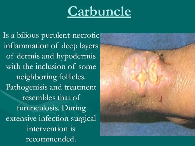 Carbuncle Is a bilious purulent-necrotic inflammation of deep layers of dermis