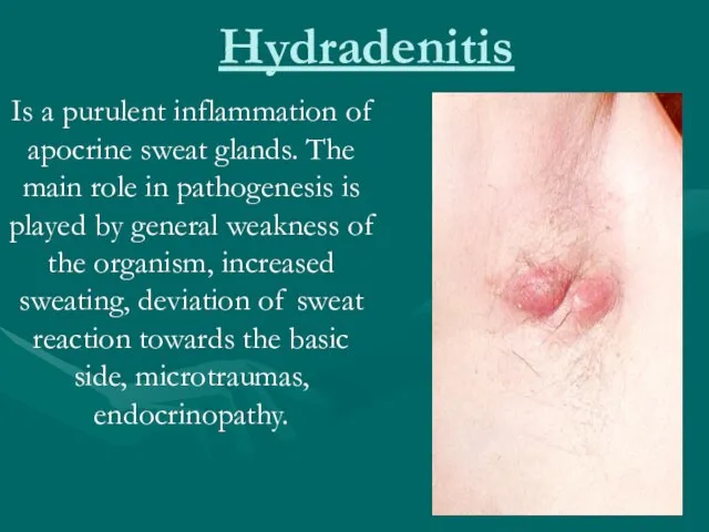 Hydradenitis Is a purulent inflammation of apocrine sweat glands. The main