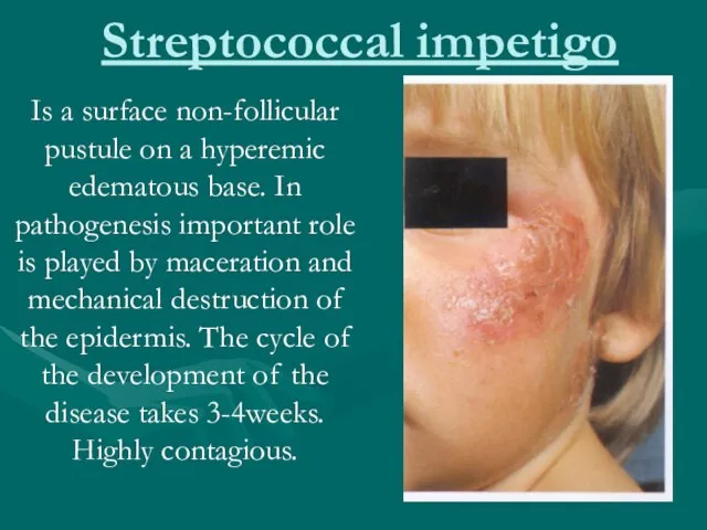 Streptococcal impetigo Is a surface non-follicular pustule on a hyperemic edematous