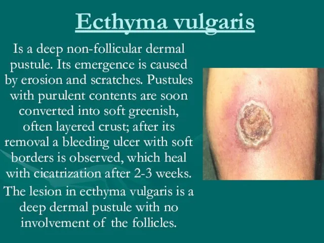 Ecthyma vulgaris Is a deep non-follicular dermal pustule. Its emergence is