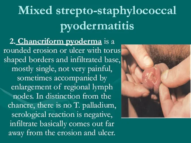 Mixed strepto-staphylococcal pyodermatitis 2. Chancriform pyoderma is a rounded erosion or