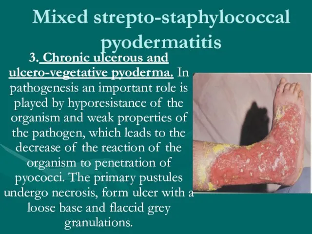 Mixed strepto-staphylococcal pyodermatitis 3. Chronic ulcerous and ulcero-vegetative pyoderma. In pathogenesis