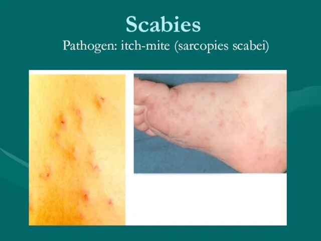 Scabies Pathogen: itch-mite (sarcopies scabei)