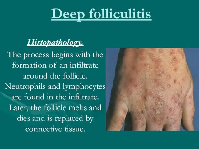 Deep folliculitis Histopathology. The process begins with the formation of an