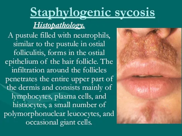 Staphylogenic sycosis Histopathology. A pustule filled with neutrophils, similar to the