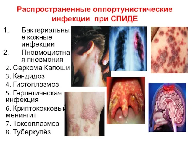 Распространенные оппортунистические инфекции при СПИДЕ Бактериальные кожные инфекции Пневмоцистная пневмония 2.