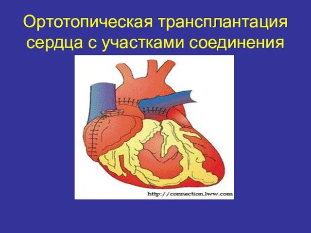 Ортотопическая трансплантация сердца с участками соединения