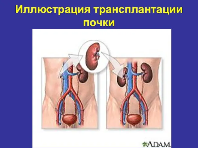 Иллюстрация трансплантации почки