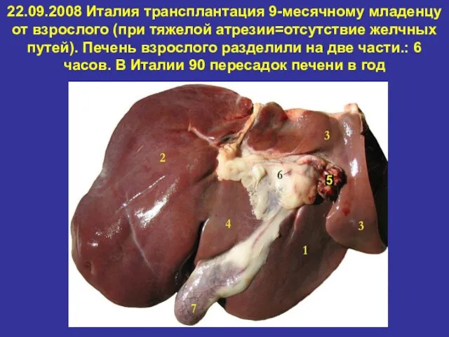 22.09.2008 Италия трансплантация 9-месячному младенцу от взрослого (при тяжелой атрезии=отсутствие желчных