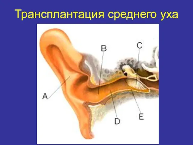 Трансплантация среднего уха