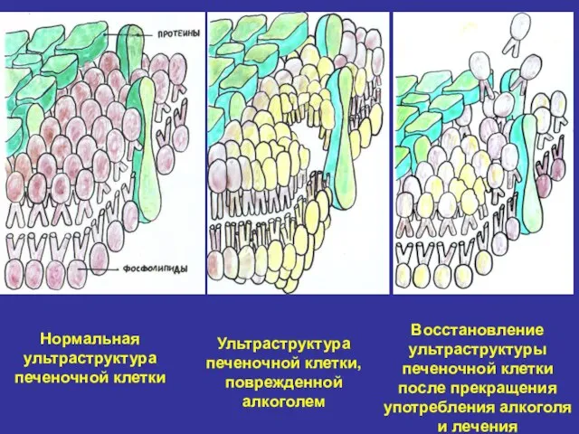 Нормальная ультраструктура печеночной клетки Ультраструктура печеночной клетки, поврежденной алкоголем Восстановление ультраструктуры