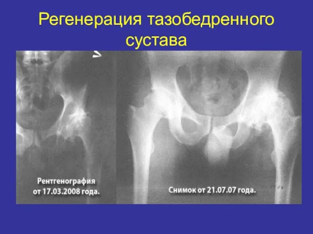 Регенерация тазобедренного сустава