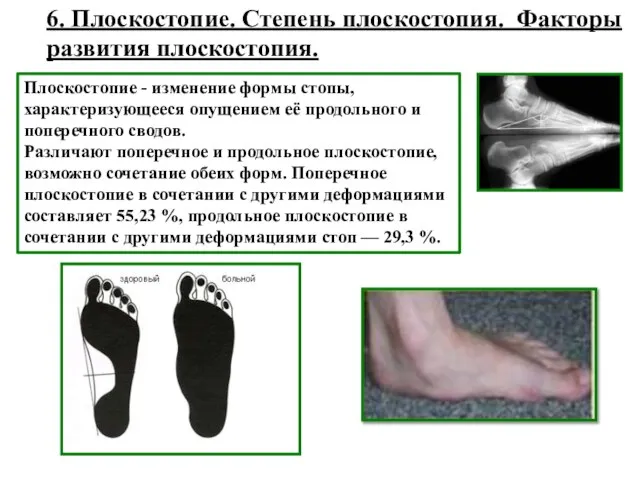 6. Плоскостопие. Степень плоскостопия. Факторы развития плоскостопия. Плоскостопие - изменение формы