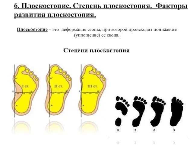 6. Плоскостопие. Степень плоскостопия. Факторы развития плоскостопия. Плоскостопие – это деформация