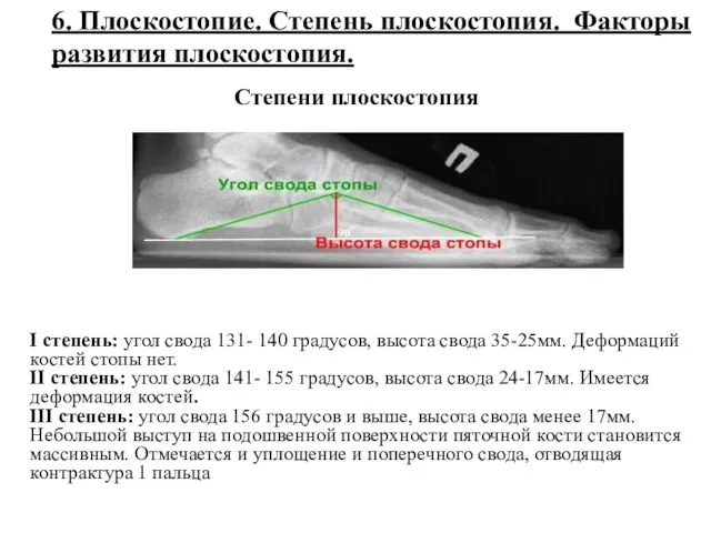 6. Плоскостопие. Степень плоскостопия. Факторы развития плоскостопия. Степени плоскостопия I степень: