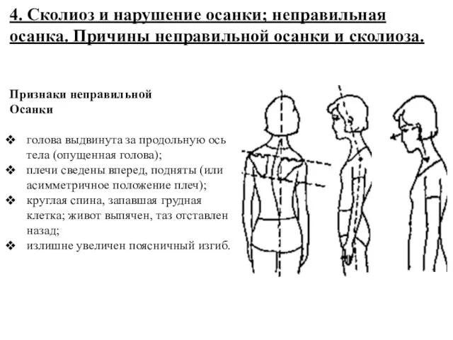 Признаки неправильной Осанки голова выдвинута за продольную ось тела (опущенная голова);