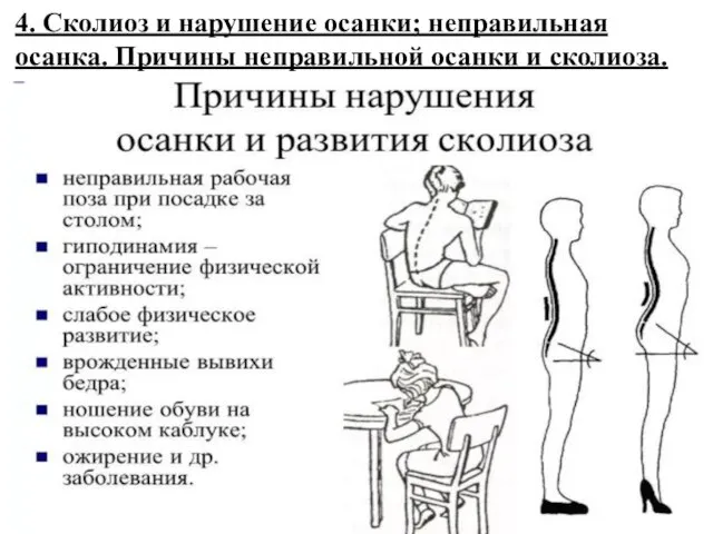 4. Сколиоз и нарушение осанки; неправильная осанка. Причины неправильной осанки и сколиоза.