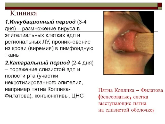 1.Инкубационный период (3-4 дня) – размножение вируса в эпителиальных клетках вдп