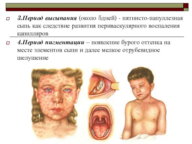 3.Период высыпания (около 5дней) - пятнисто-папуллезная сыпь как следствие развития периваскулярного