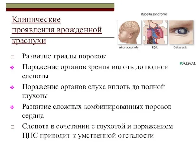 Клинические проявления врожденной краснухи Развитие триады пороков: Поражение органов зрения вплоть