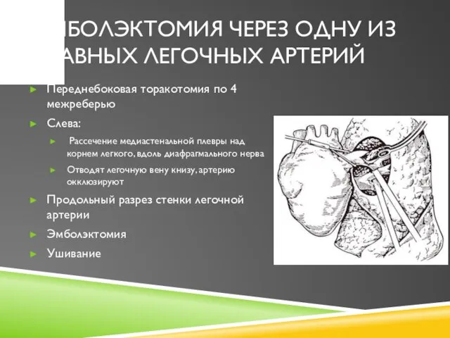 ЭМБОЛЭКТОМИЯ ЧЕРЕЗ ОДНУ ИЗ ГЛАВНЫХ ЛЕГОЧНЫХ АРТЕРИЙ Переднебоковая торакотомия по 4