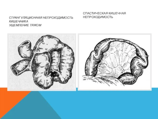 СТРАНГУЛЯЦИОННАЯ НЕПРОХОДИМОСТЬ КИШЕЧНИКА УЩЕМЛЕНИЕ ТЯЖОМ СПАСТИЧЕСКАЯ КИШЕЧНАЯ НЕПРОХОДИМОСТЬ