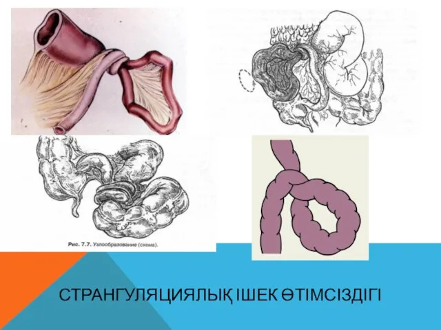 СТРАНГУЛЯЦИЯЛЫҚ ІШЕК ӨТІМСІЗДІГІ