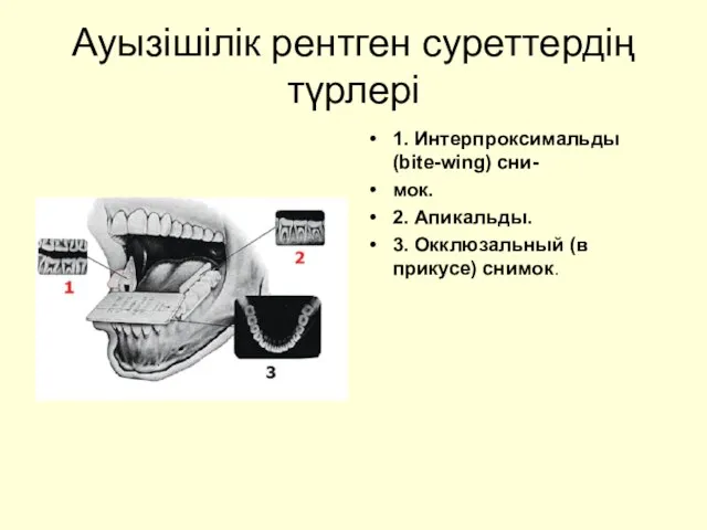 Ауызішілік рентген суреттердің түрлері 1. Интерпроксимальды (bite-wing) сни- мок. 2. Апикальды. 3. Окклюзальный (в прикусе) снимок.