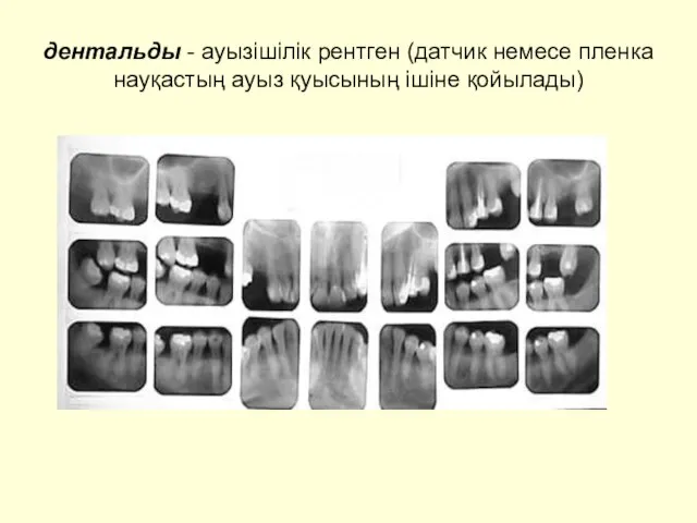 дентальды - ауызішілік рентген (датчик немесе пленка науқастың ауыз қуысының ішіне қойылады)