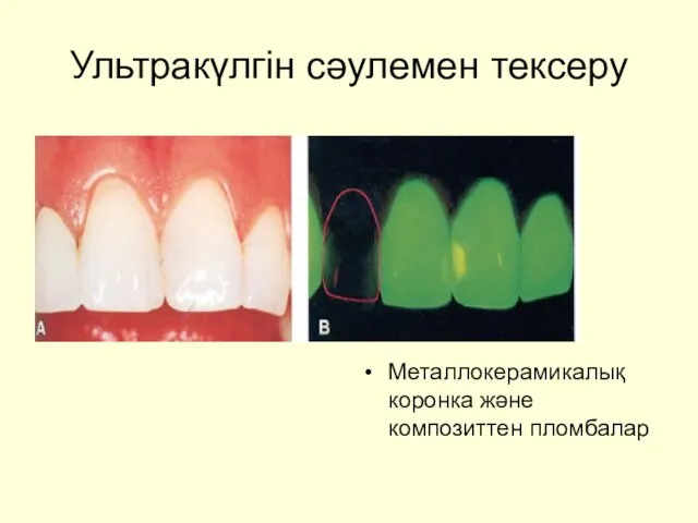 Ультракүлгін сәулемен тексеру Металлокерамикалық коронка және композиттен пломбалар