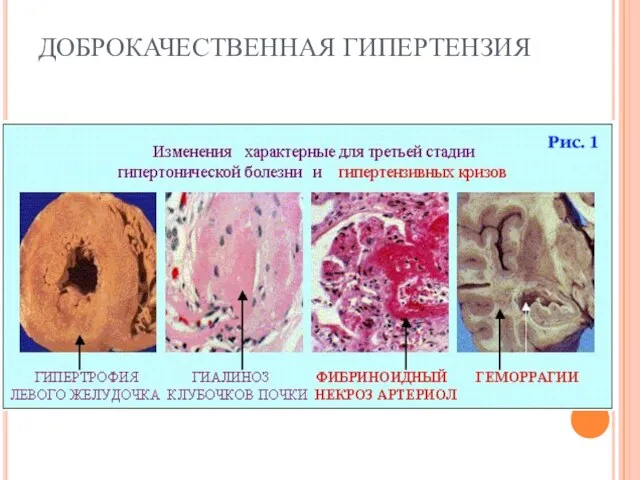 ДОБРОКАЧЕСТВЕННАЯ ГИПЕРТЕНЗИЯ