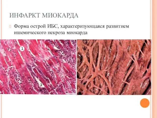 ИНФАРКТ МИОКАРДА Форма острой ИБС, характеризующаяся развитием ишемического некроза миокарда