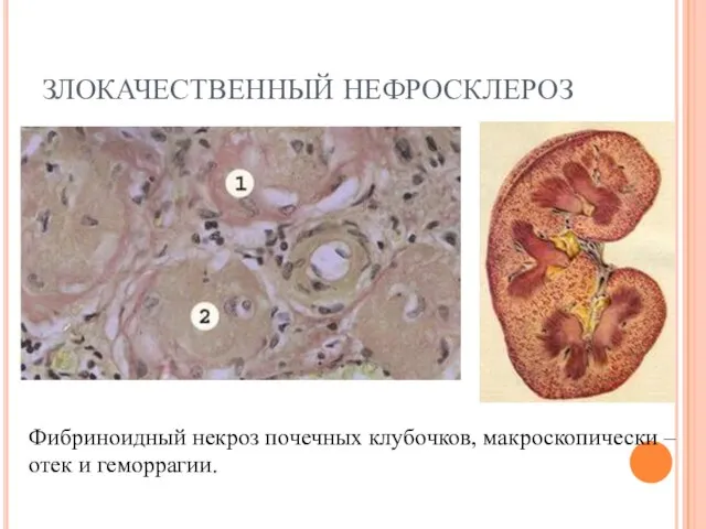 ЗЛОКАЧЕСТВЕННЫЙ НЕФРОСКЛЕРОЗ Фибриноидный некроз почечных клубочков, макроскопически – отек и геморрагии.