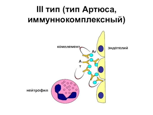 III тип (тип Артюса, иммуннокомплексный)