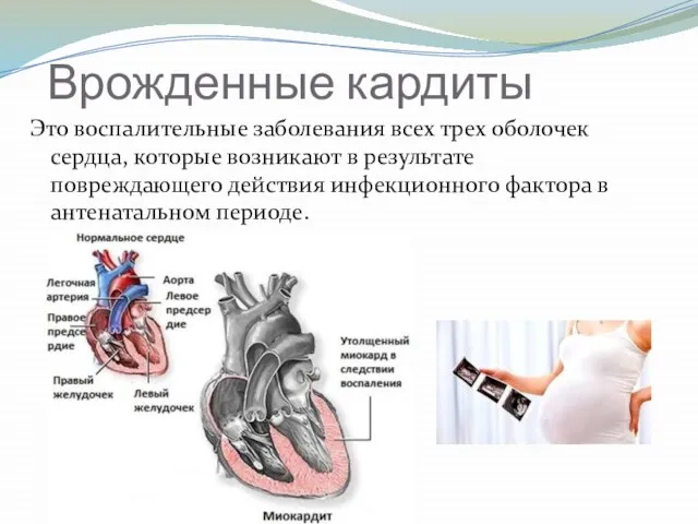 Врожденные кардиты Это воспалительные заболевания всех трех оболочек сердца, которые возникают