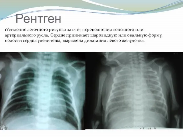 Рентген 1Усиление легочного рисунка за счет переполнения венозного или артериального русла.