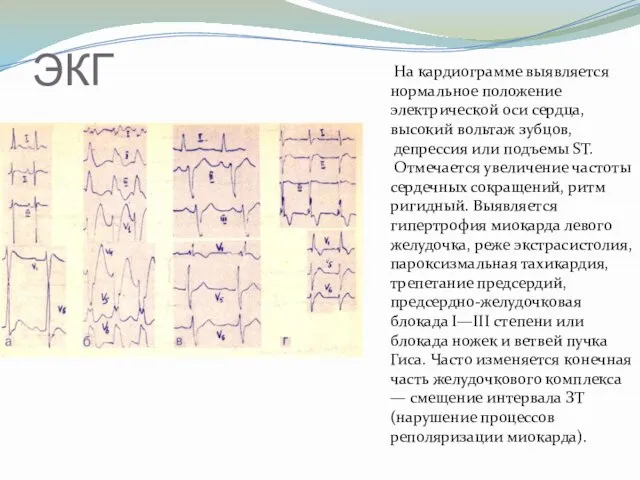 ЭКГ На кардиограмме выявляется нормальное положение электрической оси сердца, высокий вольтаж