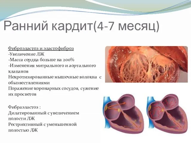 Ранний кардит(4-7 месяц) Фиброэластоз и эластофиброз -Увеличение ЛЖ -Масса сердца больше