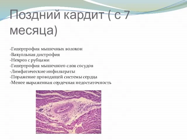Поздний кардит ( с 7 месяца) -Гипертрофия мышечных волокон -Вакуольная дистрофия