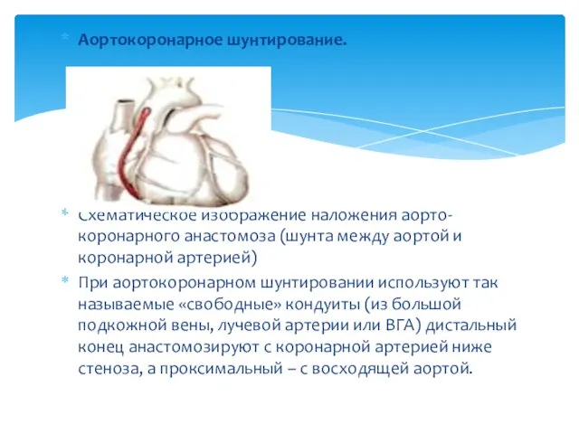 Аортокоронарное шунтирование. Схематическое изображение наложения аорто-коронарного анастомоза (шунта между аортой и