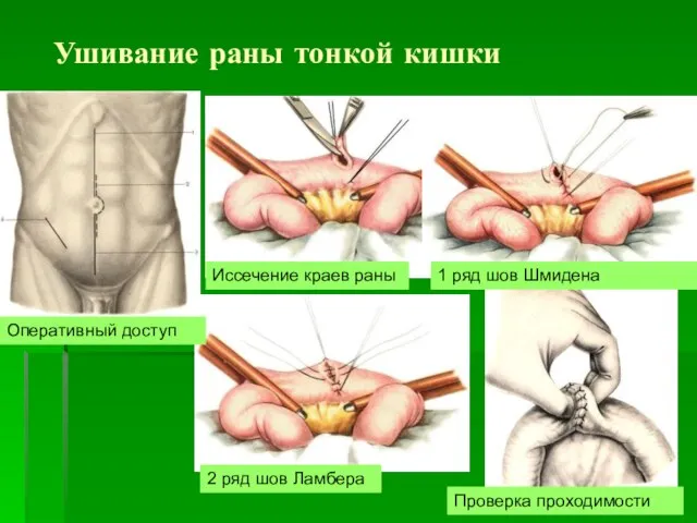 Ушивание раны тонкой кишки Иссечение краев раны Оперативный доступ 1 ряд