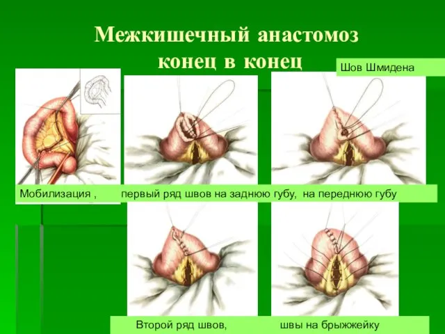 Межкишечный анастомоз конец в конец Мобилизация , первый ряд швов на