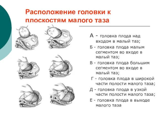 Расположение головки к плоскостям малого таза А - головка плода над