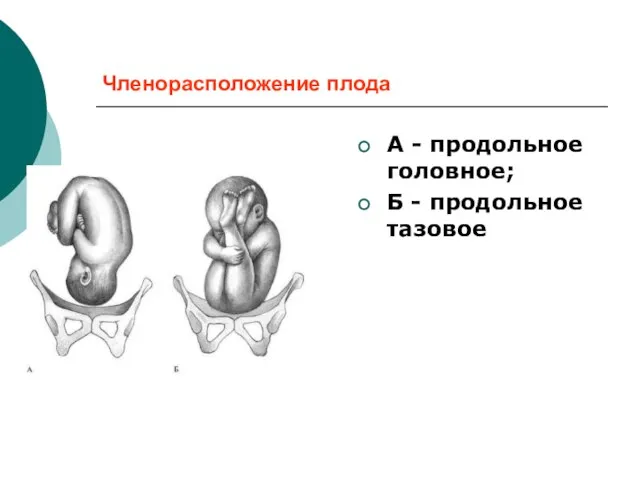 Членорасположение плода А - продольное головное; Б - продольное тазовое