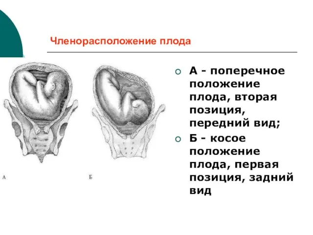 Членорасположение плода А - поперечное положение плода, вторая позиция, передний вид;