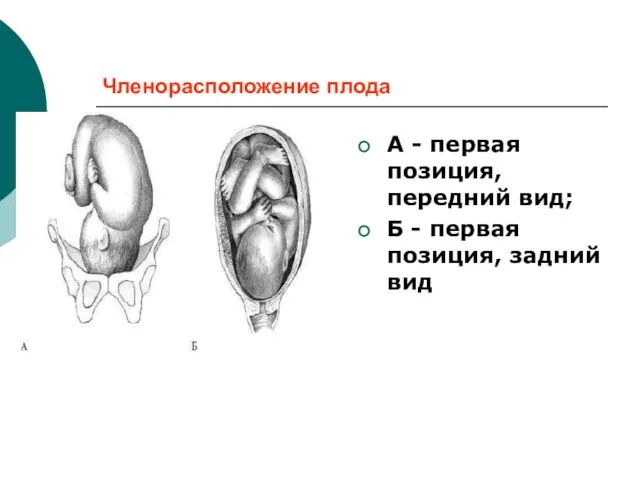 Членорасположение плода А - первая позиция, передний вид; Б - первая позиция, задний вид