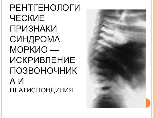 РЕНТГЕНОЛОГИЧЕСКИЕ ПРИЗНАКИ СИНДРОМА МОРКИО — ИСКРИВЛЕНИЕ ПОЗВОНОЧНИКА И ПЛАТИСПОНДИЛИЯ.