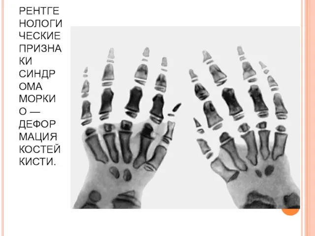 РЕНТГЕНОЛОГИЧЕСКИЕ ПРИЗНАКИ СИНДРОМА МОРКИО — ДЕФОРМАЦИЯ КОСТЕЙ КИСТИ.